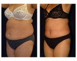 Tummy Tuck / Abdominoplasty