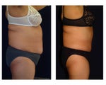Tummy Tuck / Abdominoplasty