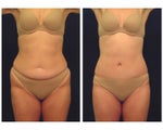 Tummy Tuck / Abdominoplasty