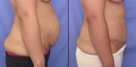 Tummy tuck
