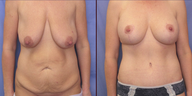 Abdominoplasty