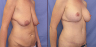 Abdominoplasty and breast lift
