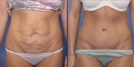 Abdominoplasty