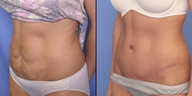Abdominoplasty