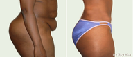 Tummy Tuck