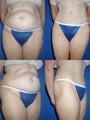 Tummy Tuck