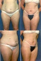 Tummy Tuck