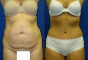 Tummy Tuck