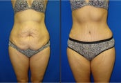 Tummy Tuck