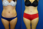 Tummy Tuck
