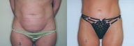 Abdominoplasty