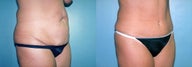 Tummy Tuck & Lipo