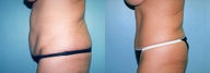 Tummy Tuck & Lipo