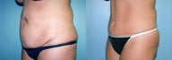 Tummy Tuck & Lipo