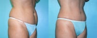 Tummy Tuck