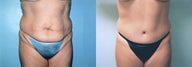 Tummy Tuck