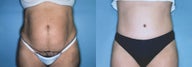 Post Pregnancy Abdominoplasty