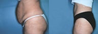Post Pregnancy Abdominoplasty
