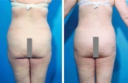 Abdominoplasty