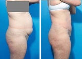 Abdominoplasty
