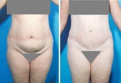 Abdominoplasty