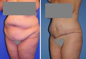Abdominoplasty
