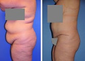 Abdominoplasty