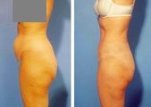 Abdominoplasty