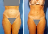Abdominoplasty
