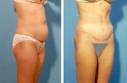 Abdominoplasty