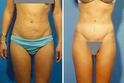 Abdominoplasty