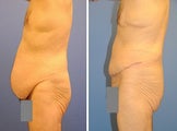 Abdominoplasty
