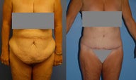 Abdominoplasty