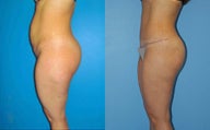 Abdominoplasty