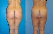 Abdominoplasty