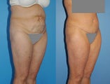 Abdominoplasty