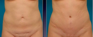 Tummy Tuck