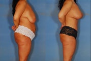 Tummy Tuck