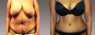 Tummy Tuck