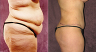 Tummy Tuck