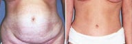 Tummy Tuck