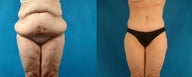 Tummy Tuck
