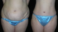 Tummy Tuck