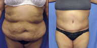 Tummy Tuck and Liposuction