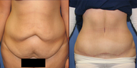 Tummy tuck