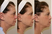 Ultherapy