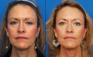 Ultherapy