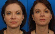 Ultherapy