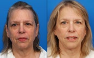 Ultherapy
