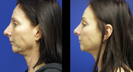 Ultherapy 
